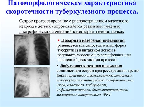 Что такое фаза распада при туберкулезе?