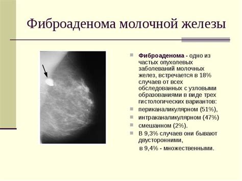 Что такое фиброма груди и как она возникает?