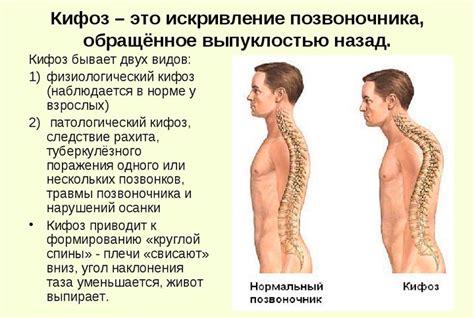 Что такое физиологический кифоз грудного отдела позвоночника?