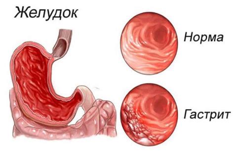 Что такое хронический гастрит