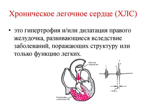 Что такое хроническое легочное сердце?