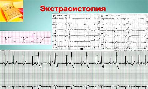 Что такое частая желудочковая экстрасистолия?