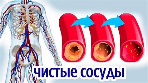 Что такое чистка сосудов