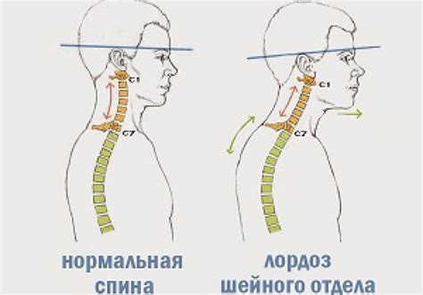 Что такое шейный лордоз?