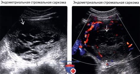 Что такое эндометрий повышенной эхогенности?