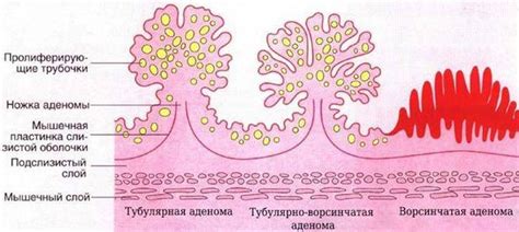 Что такое эпителиальные образования ободочной кишки?