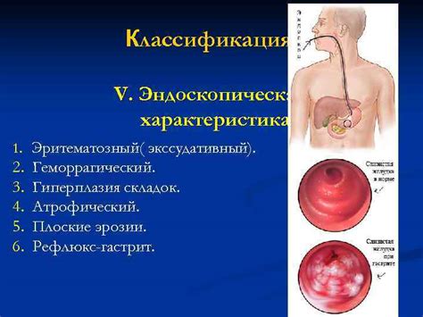 Что такое эритематозная антральная гастропатия?