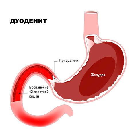 Что такое эритематозная дуоденопатия?