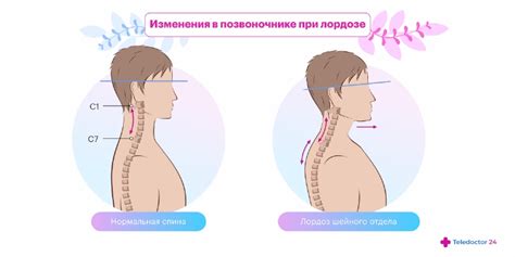 Шейный лордоз сохранен у ребенка