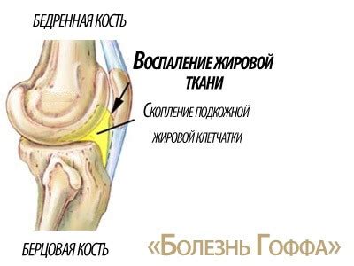 Шишка под коленом: причины, симптомы, лечение