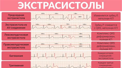 ЭКГ: наджелудочковая экстрасистолия