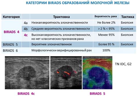 Экспертное мнение о внутрипротоковом образовании молочной железы