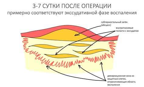 Экссудативная фаза воспалительного процесса