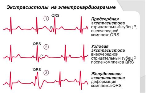 Экстрасистола: что это и как она возникает?