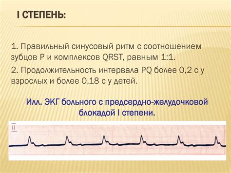 Электрокардиограмма при нарушении межжелудочковой проводимости сердца