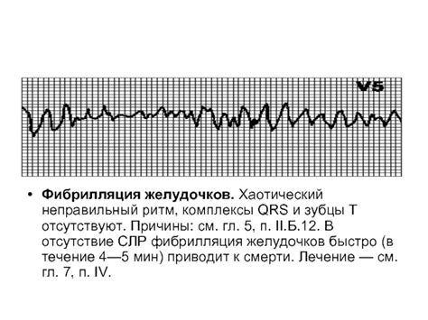 Электрокардиография и неправильный ритм QRS