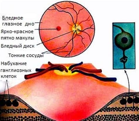 Эмболия сосудов глаза