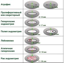 Эндометрий однородный аваскулярный