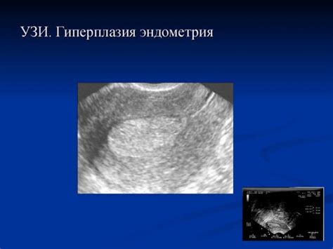 Эндометриозная киста: основные сведения и характеристики