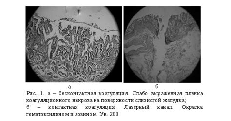 Эрозивные поражения желудочной стенки