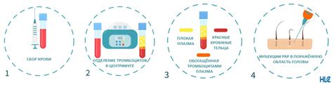 Этапы процедуры срезания скальпа