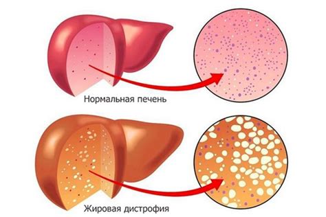 Эффективное лечение липидоза печени