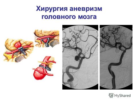 Эффективные методы лечения неоднородности сосудистых сплетений