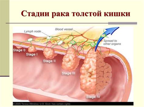 Эффективные методы лечения низкодифференцированной аденокарциномы толстой кишки g3