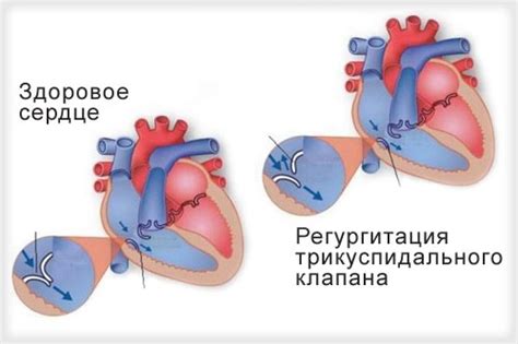 Эффекты закрытия клапана сердца на организм