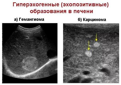 Эхогенность печени: роль и значение в оценке здоровья