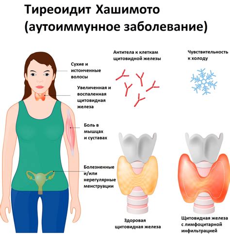 Эхографические признаки аутоиммунного тиреоидита