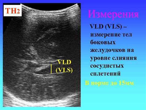 Эхопризнаки гепатоспленомегалии