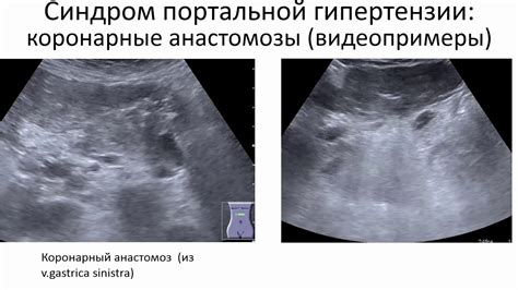 Эхопризнаки диффузных изменений печени и их значение