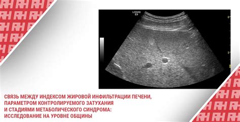 Эхопризнаки жировой инфильтрации печени