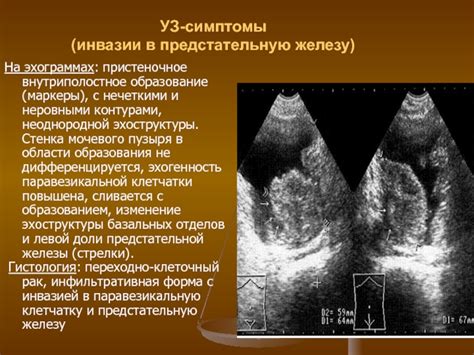 Эхоструктура диффузно неоднородная