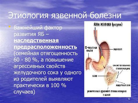 Язвенная болезнь желудка: понимание симптомов и диагностика