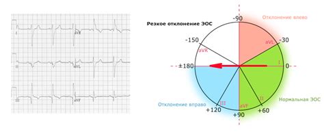  Горизонтальная электрическая ось сердца 