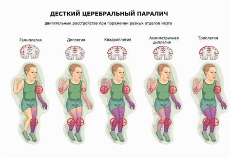  ДЦП (детский церебральный паралич) 