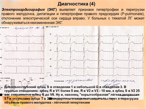  Какие ограничения следует соблюдать при перегрузке левого предсердия? 