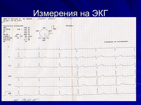  Клиническое значение отрицательной динамики на ЭКГ 