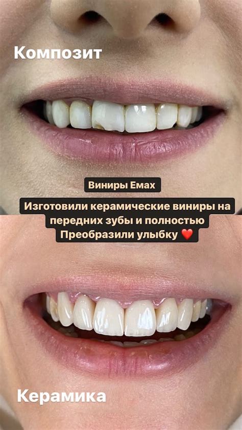  Кто может использовать композитные виниры? 