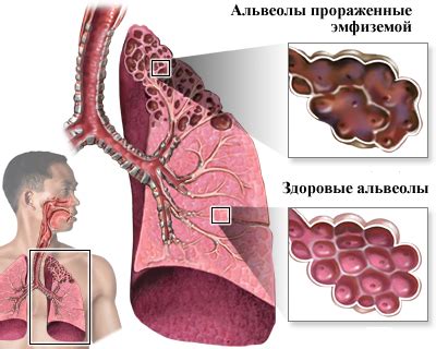  Методы диагностики эмфиземы легкого 