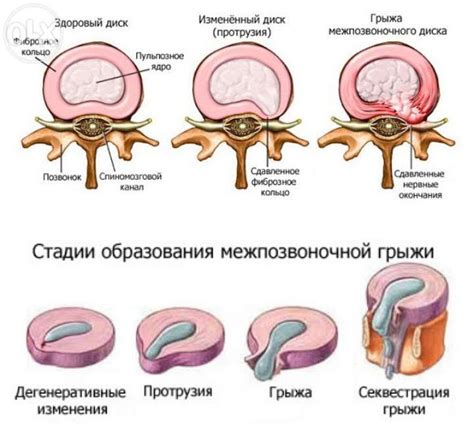  Позвоночные грыжи и выпадение дисков 