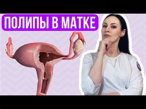  Почему необходимо удалить полипы в полости матки? 