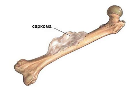  Причины возникновения легкой кости 