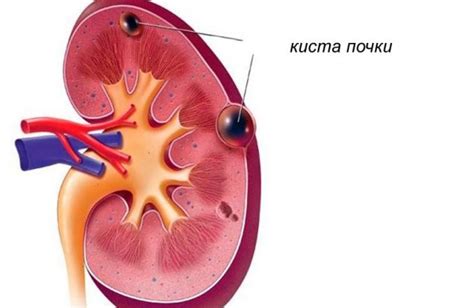  Симптомы микролита правой почки 