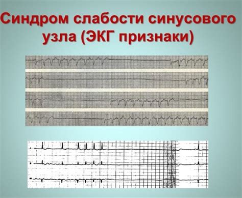  Синдром слабости синусового узла: причины, симптомы и лечение 