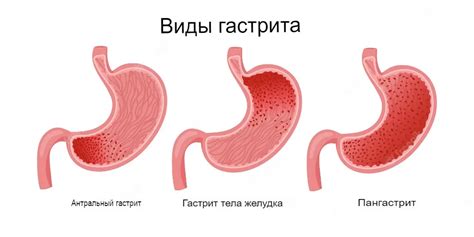  Что такое гастрит с эрозиями? 