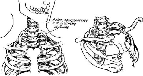  Шейное ребро 1 степени с обеих сторон 